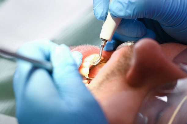 Best Knocked-Out Tooth (Avulsed Tooth) Treatment in Ofallon, IL